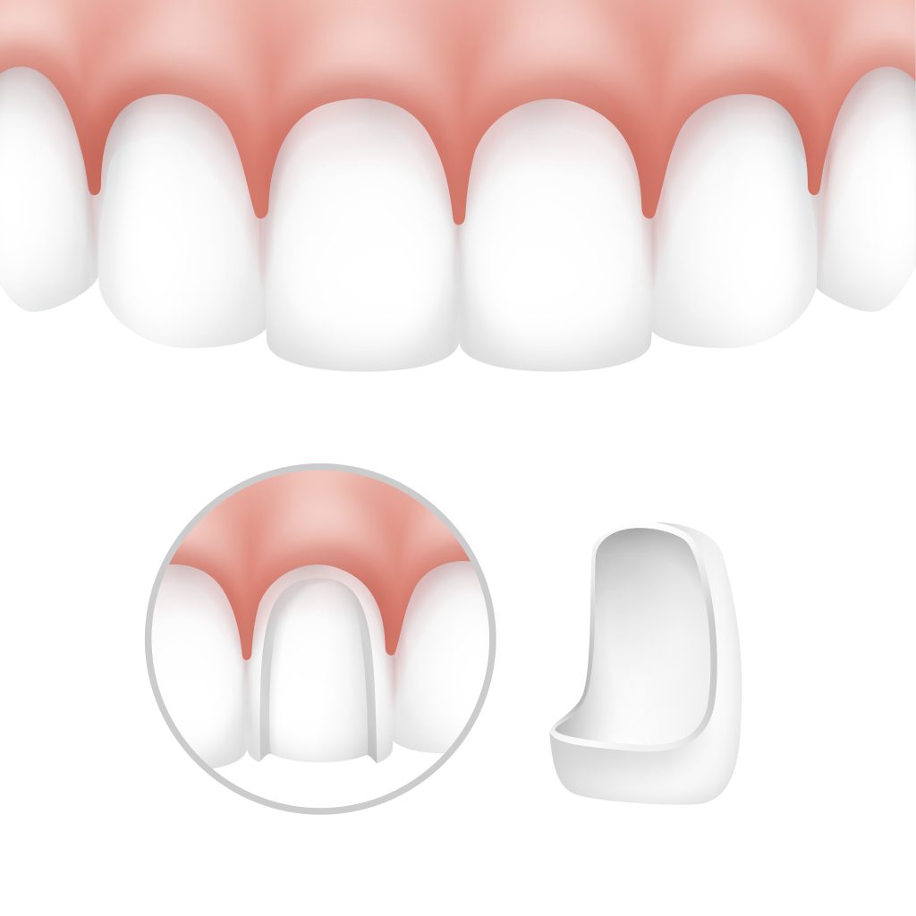 Dental Veneers