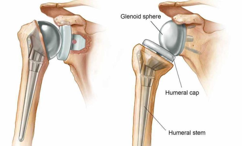 Shoulder Replacement Surgery