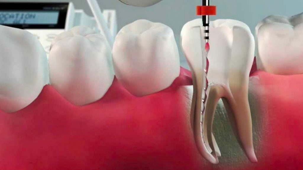 root canal treatment in Dubai